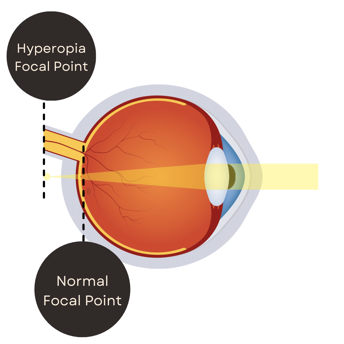 Hyperopia eye problem